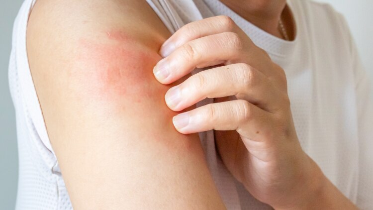 202505_buyingguide_eczema_750x422.jpg